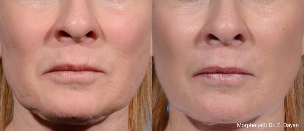 Non-Surgical Facelift