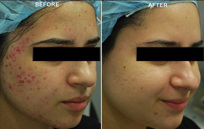 Non-Surgical Facelift