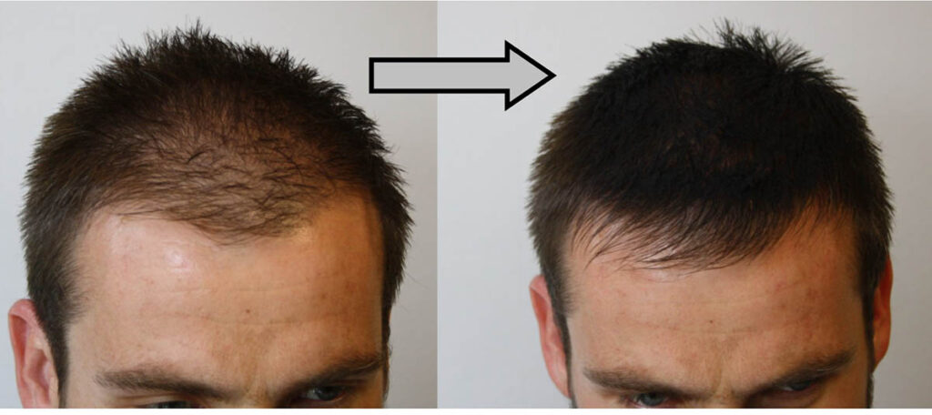 Hair loss? Full, thick hair is just a few sprays away - HN Magazine