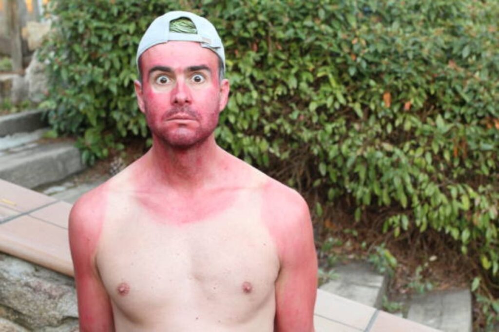 treat your burns