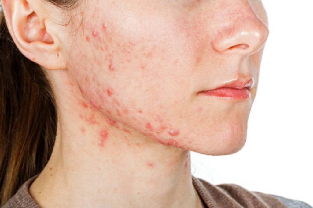 adult acne