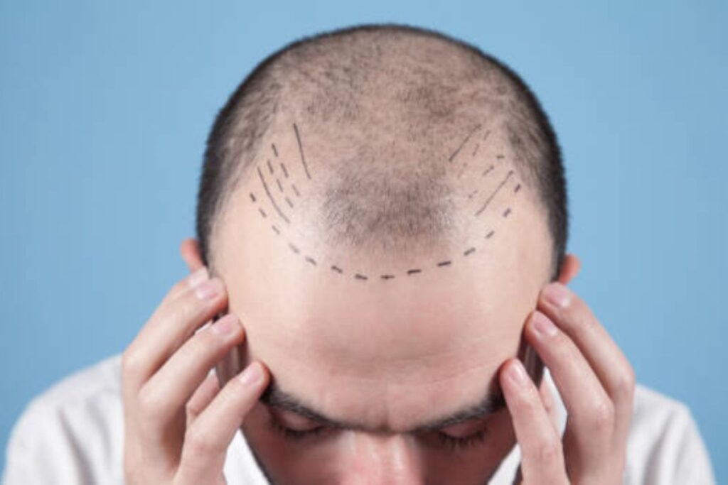 hair restoration