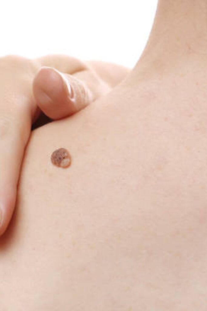 lumps bumps and skin tags