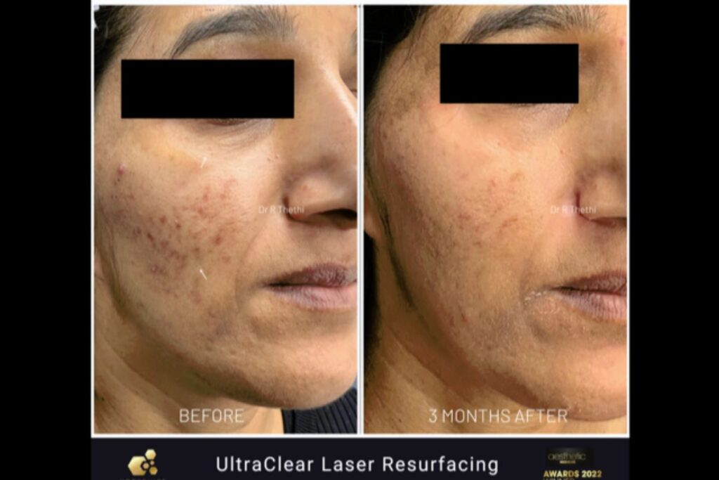 skin resurfacing
