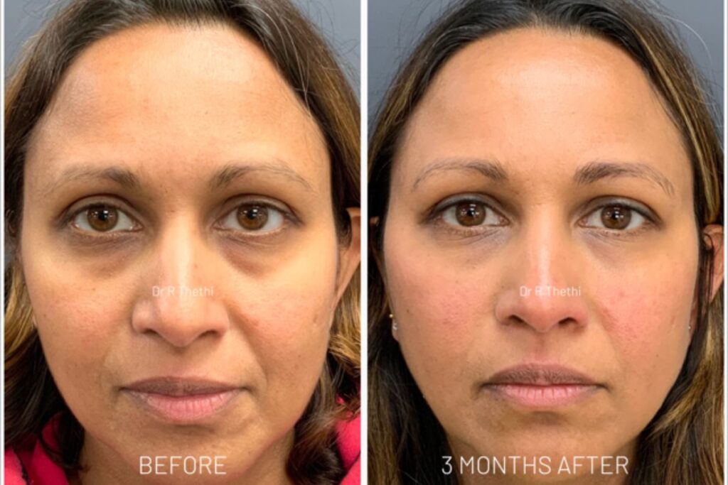skin resurfacing