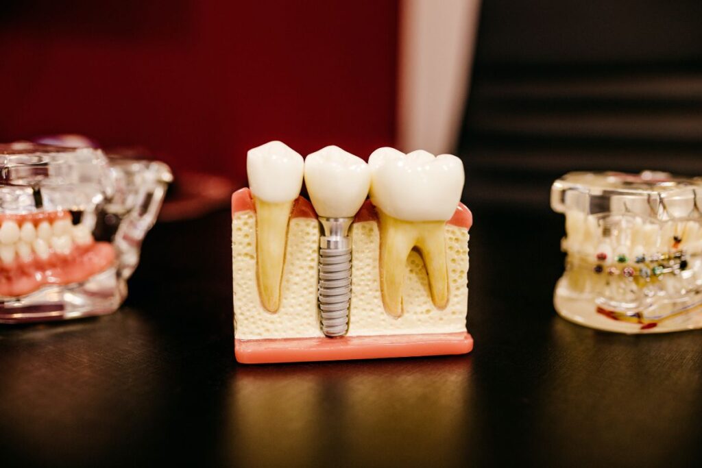 dental treatments implants