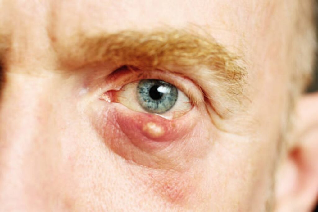 cyst surgery
