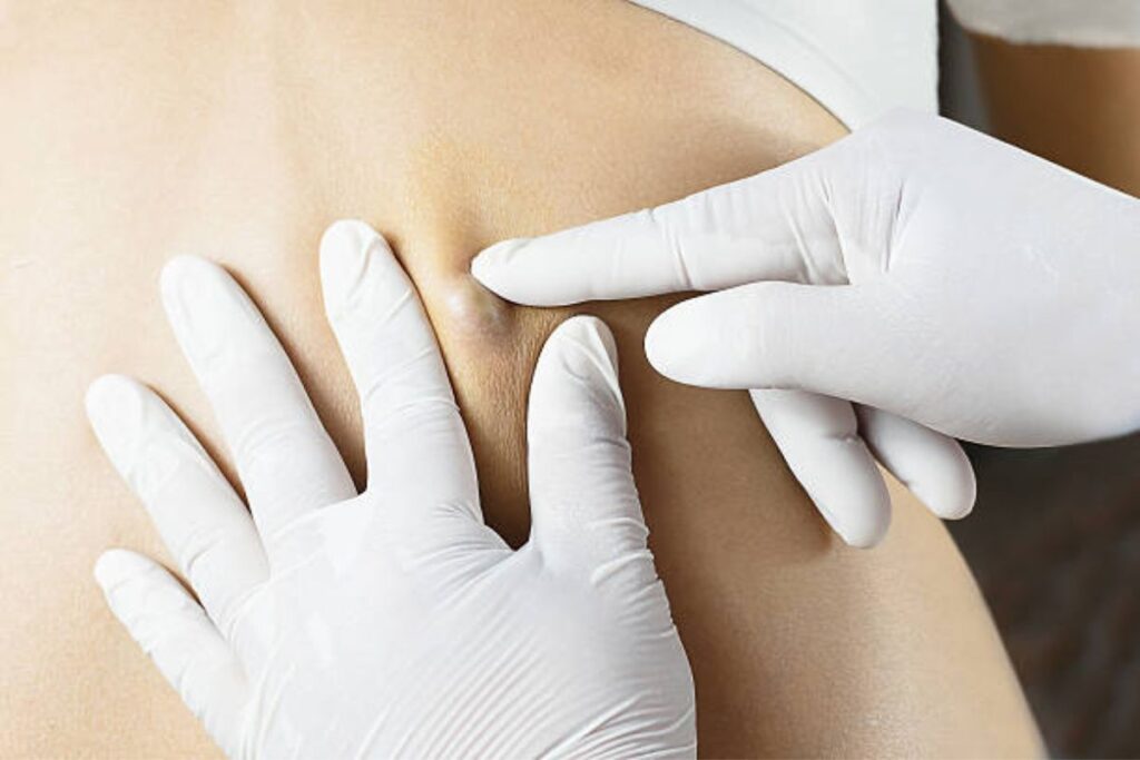 cyst surgery