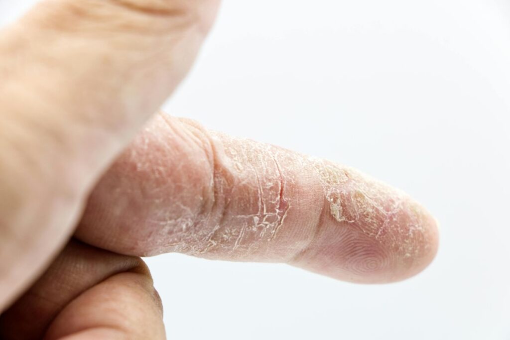 skin conditions eczema
