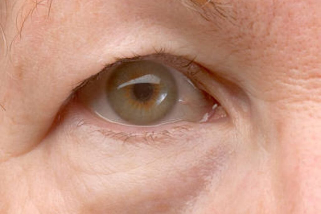 drooping eyelids