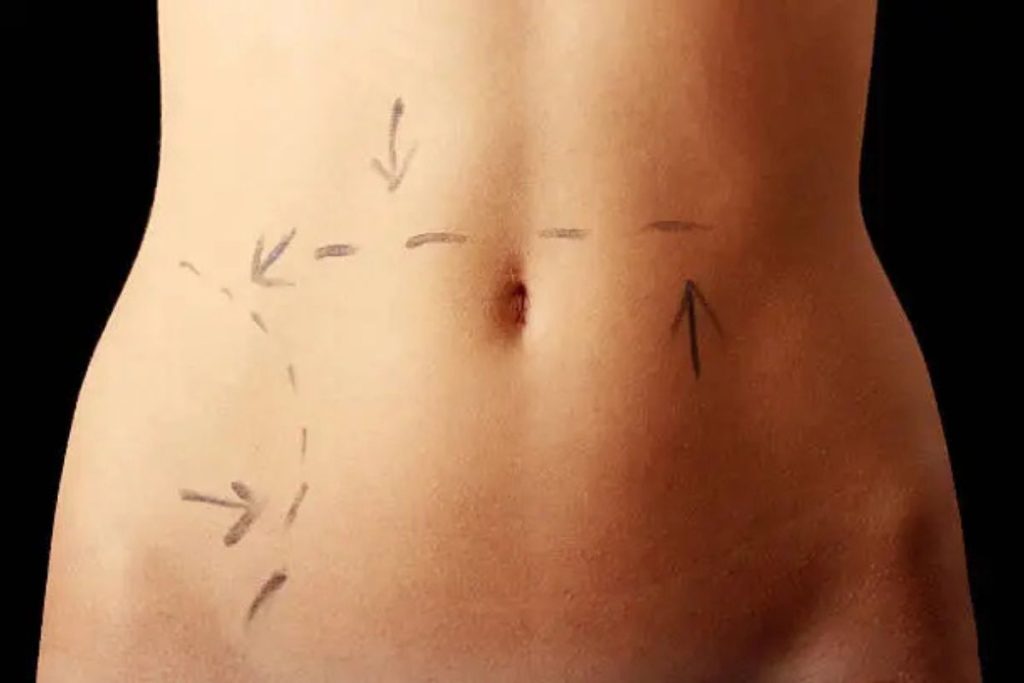 body enhancement tummy tuck