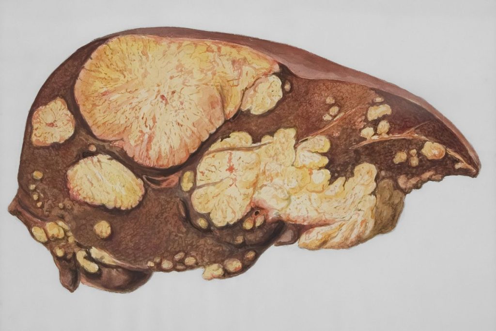 liver cancer
