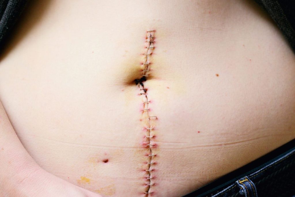 recovery from surgery