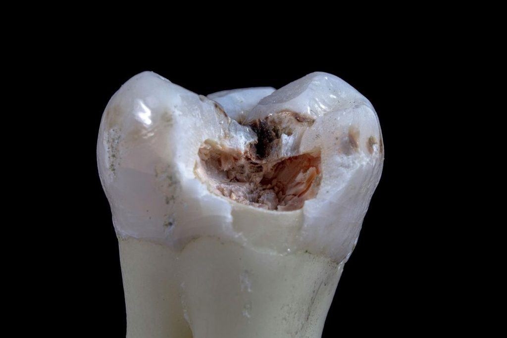 damaged tooth and a crown